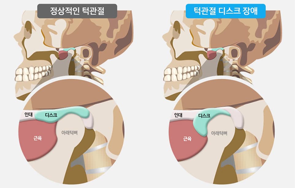 턱관절 구조